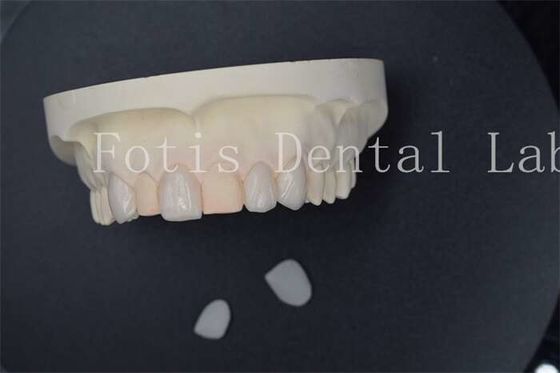 buy Custom Artificial Dental Lab Veneers With Superior Stain Resistance online manufacturer