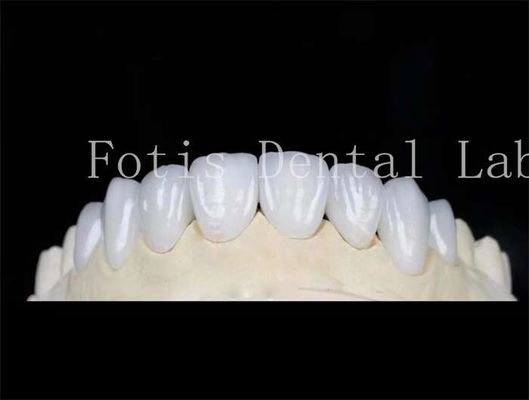 buy Natural Color Dental Laminate Veneers Fake Teeth Veneers With Bonding Cement online manufacturer