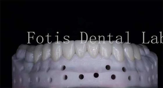 buy OEM ODM Stain Resistant Natural Looking Porcelain Veneers High Strength online manufacturer