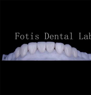 buy Long Lasting Smooth Texture Teeth Cover Veneers Natural Dental Veneers online manufacturer
