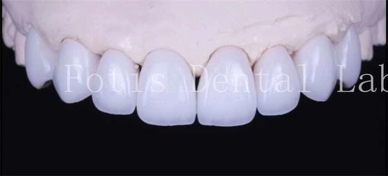 buy Adhesive Bonding Cement Natural White Veneers With High Translucency online manufacturer