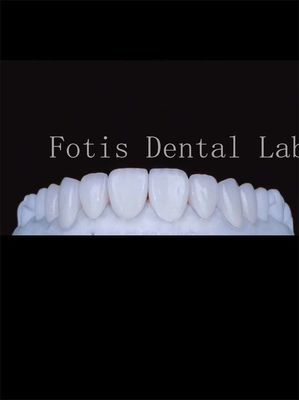 buy High Translucency Porcelain Tooth Veneers Enhance Your Smile Naturally online manufacturer