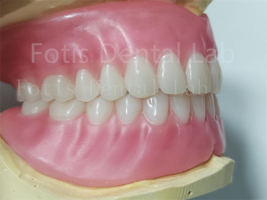 Ivoclar Teeth Full Acrylic Denture Prosthesis Easy To Clean High Durability