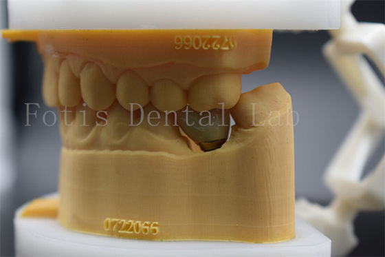 Long Lasting Polished Dental Lab Crowns Precision Fit Comfort For Patients