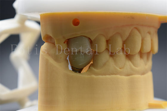 Customizable Dental Implant Abutment Crown Comfortable For Patients