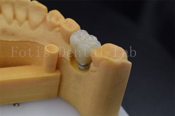 Easy To Place And Adjust Implant Retained Crown Polished Surface Treatment