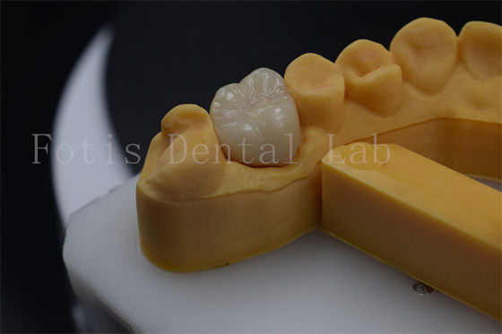 Titanium / PFM Denture Crown Customizable Zirconia Implant Crown Durable