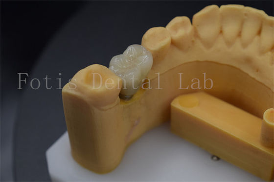 Long Lasting Comfortable  Dental Implant Crowns For Restoration Of Missing Teeth