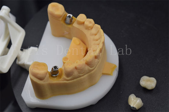 Easy To Place Zirconia Teeth Crown Titanium Crowns For Teeth Customised