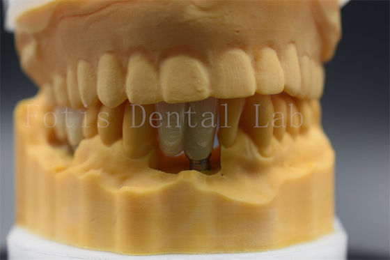 Custom Made Dental Implant Crown Precision Fit For Missing Teeth