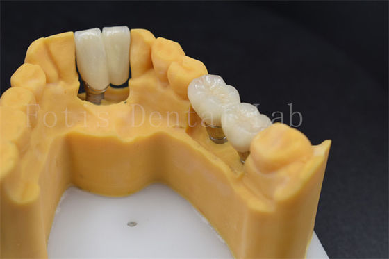Customizable Dental Restoration Implant Crown Replacement Various Sizes