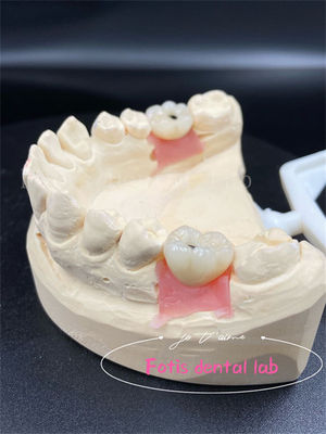 Customization Titanium/Ziconia/PFM Dental Lab Crowns Comfortable