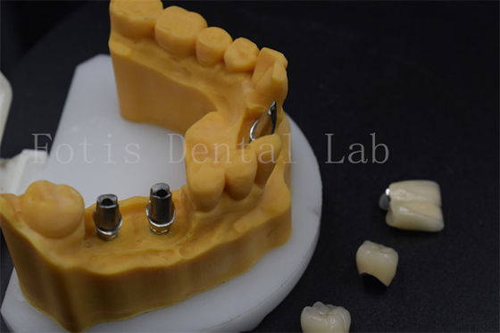 High Durability Tooth Implant Crown Easy To Adjust Dental Implant Guide Sleeves