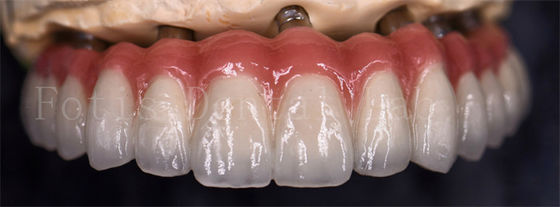 Staining Resistance  Dental Lab Crowns For Various Tooth Replacements
