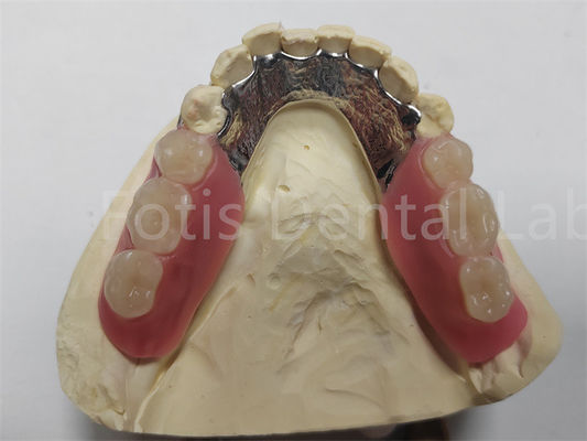 buy OEM Flexible Removable Partial Denture  Easy To Clean / Maintain online manufacturer