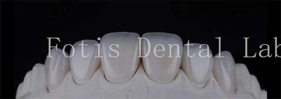 Smooth Polished Ceramic Laminate Veneers In Dentistry Smile Creators