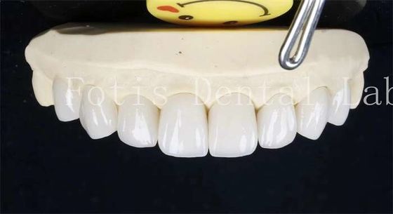 0.3-0.5mm Ceramic Laminate Teeth False Teeth Veneers With Adhesive Bonding Cement