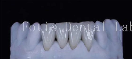 Thin Synthetic Laminate Veneer Teeth 0.3-0.5mm Thick Beautiful  Looking