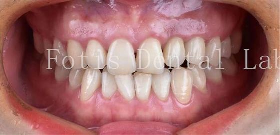 Cosmetic Dentistry Dental Porcelain Veneers With High Stain Resistance