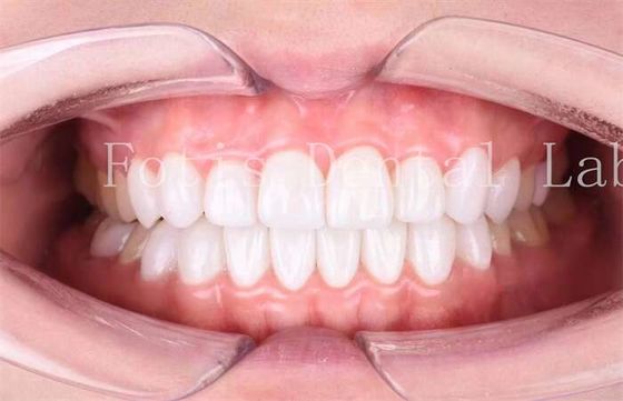 High Translucency Dental Laminate Veneers Long Lasting Durability Polishing Finishing