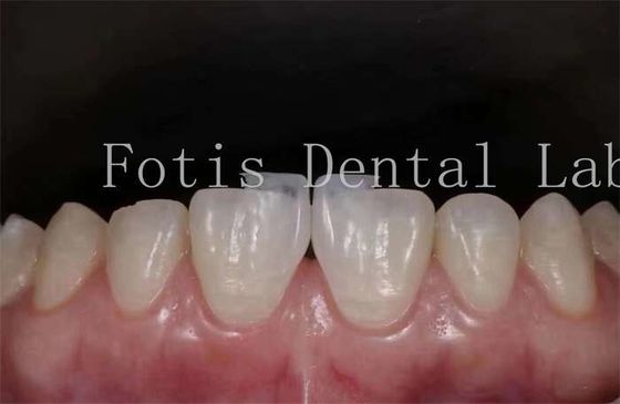 Polishing Synthetic Dental Laminate Veneers High Stain Resistance