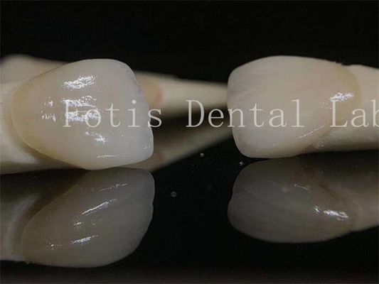 Long-lasting Dental Lab Laminate Veneers Customizable for Various Tooth Preparations