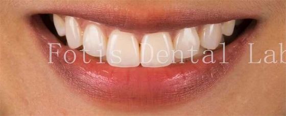 High End Cosmetic Teeth Veneers For Perfect Smile Stain Resistance