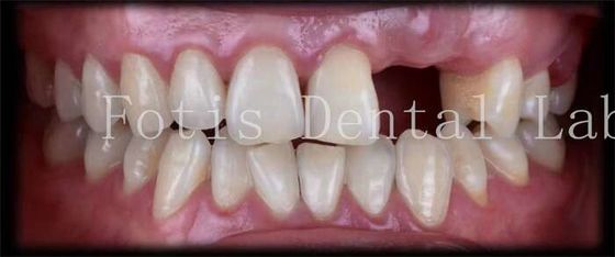 Customised Natural Temporary Dental Veneers For A Beautiful Smile