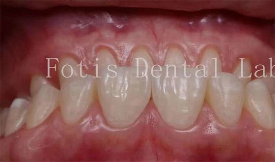 Customized Natural Looking Snap On Veneers 0.3mm-0.5mm Thickness