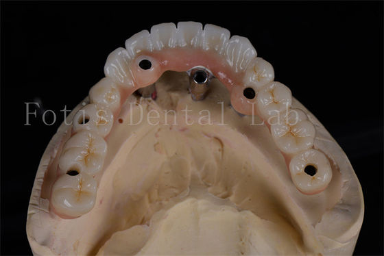 Success Rate All-on-4 Implant Dentures Same Day Procedure Affordable Full Chewing Restoration
