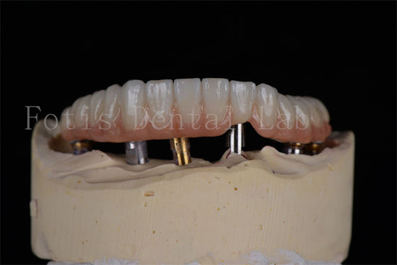 Affordable Natural Looking 4 Or 6 Implants Full Arch Success Rate Minimally Invasive Solution