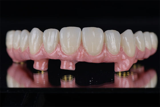 Individual All On 4 All On 6 Dental Implants Restores Full Chewing Ability