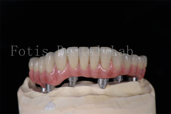 Minimally Invasive Same Day All On 4 All On 6 Implants Natural Looking Easy To Clean