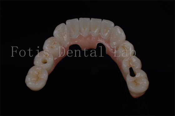 Natural Looking All On Four Teeth In A Day For Any Age Available