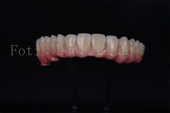 Full Arch Implant Bridge All On 4 All On 6 For Complete Dental Restoration