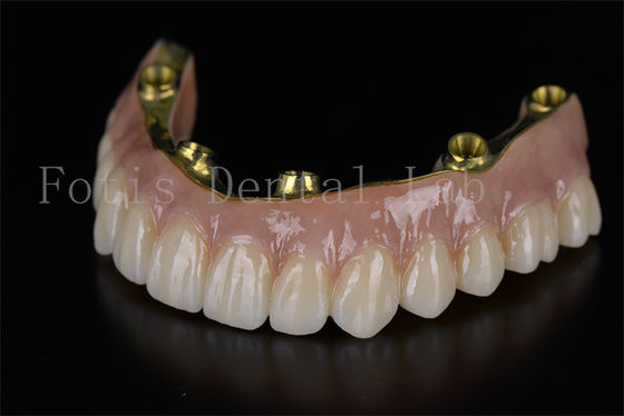 Full Arch Restoration All On Six Implants Minimally Invasive Solution