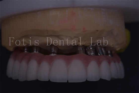 Customizable Silver Dental Crown Precision Fit For Comfortable Restoration