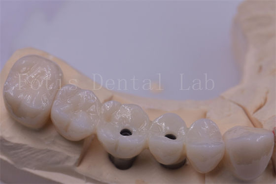 Titanium / Zirconia Dental Crown Silver Polished For Missing Teeth