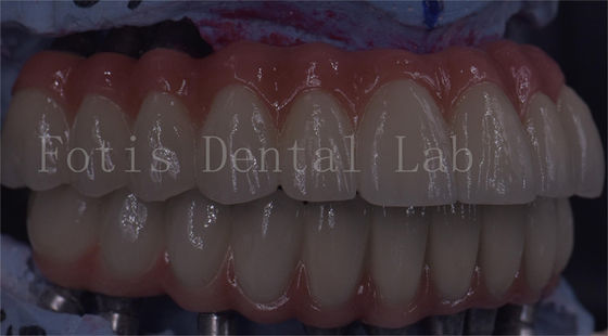 OEM Service Durable Dental Implant Temporary Crown Easy Maintenance