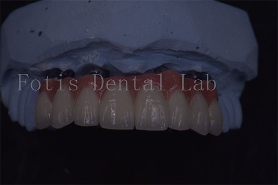 Precision Crafted Dental Implant Crowns For Superior Longevity And Comfort