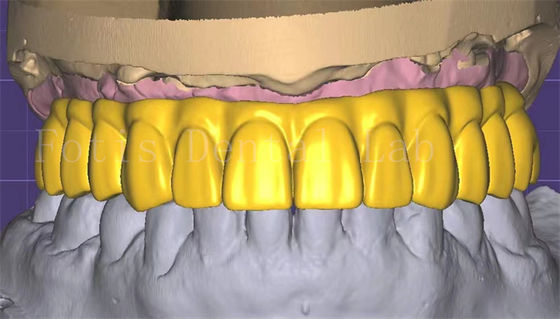 Professional  3shape Crown Design Excellent Performance And Durability