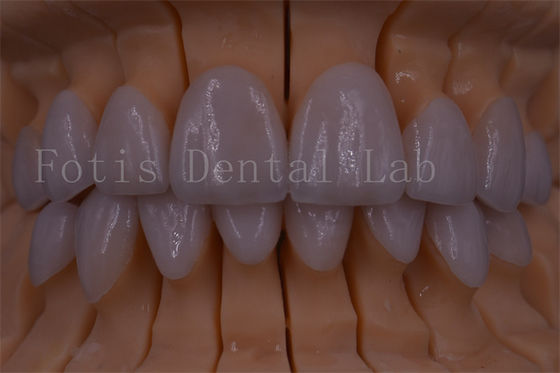 FDA/ISO/CE Certified Digital Crown Teeth Artificial Crown Any Size