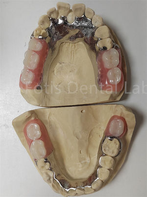 Customization Temporary Partial Dentures Compatible With Natural Teeth