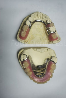 PEEK Upper Removable Partial Denture Requires Regular Maintenance