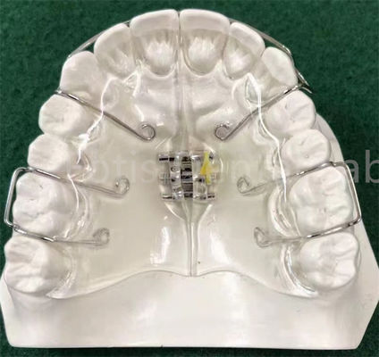 State-Of-The-Art Orthodontics Appliance Expanding Retainer Customizable