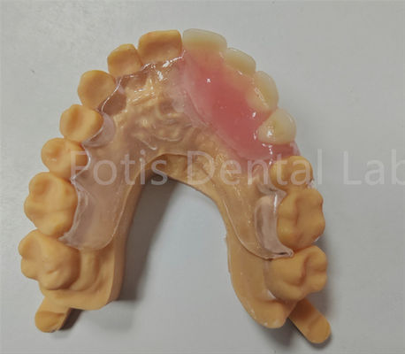 Hypoallergenic Comfort Fit Flexible Valplast Partial TCS Dental Appliance