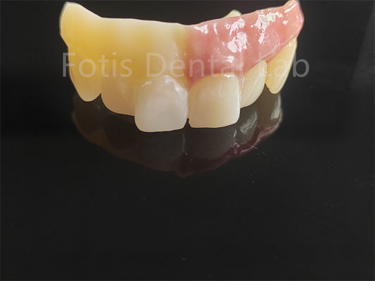 Monolithic Zirconia Layered With Porcelain Computer Aided Design