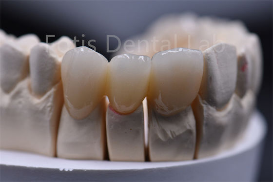 Customizable Thickness Multilayer Zirconia Ceramic Dental Material