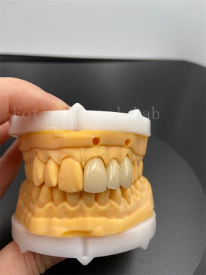 Precision Fit Digital Crowns Implant Dentrues With Compatibility Email Transmission Mode
