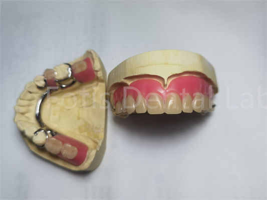 Comfortable Peek Partial Denture / Removable Dental Prosthesis Customized